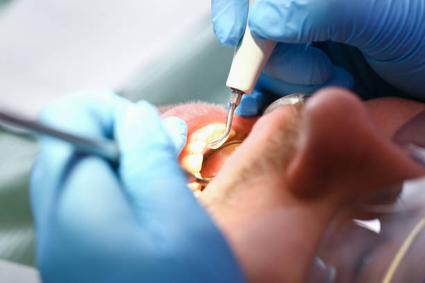 Best Emergency Dental Care for Broken or Chipped Teeth in South Gate, CA